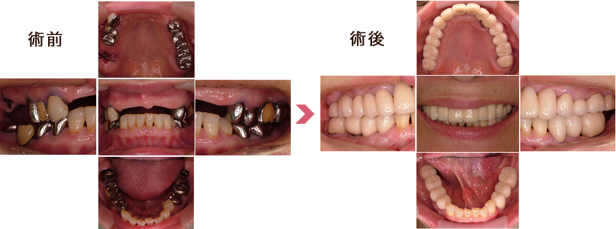 かみ合わせがかなり低くなっています。右上奥歯は予後不良のため、すでに抜歯をしています。かみ合わせも回復し、前歯もインプラント治療で固定式になりました。