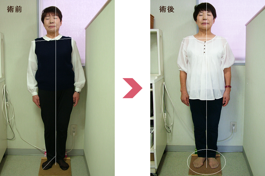 術後は身体のバランスが良くなっています。。