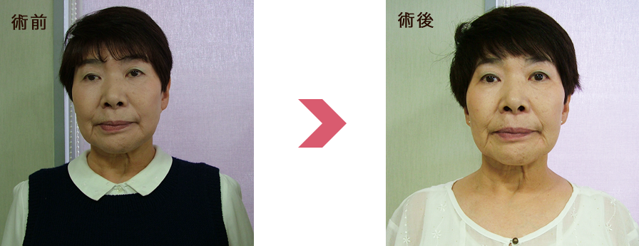 顔の歪みも良くなり、真っすぐ前を向いています。